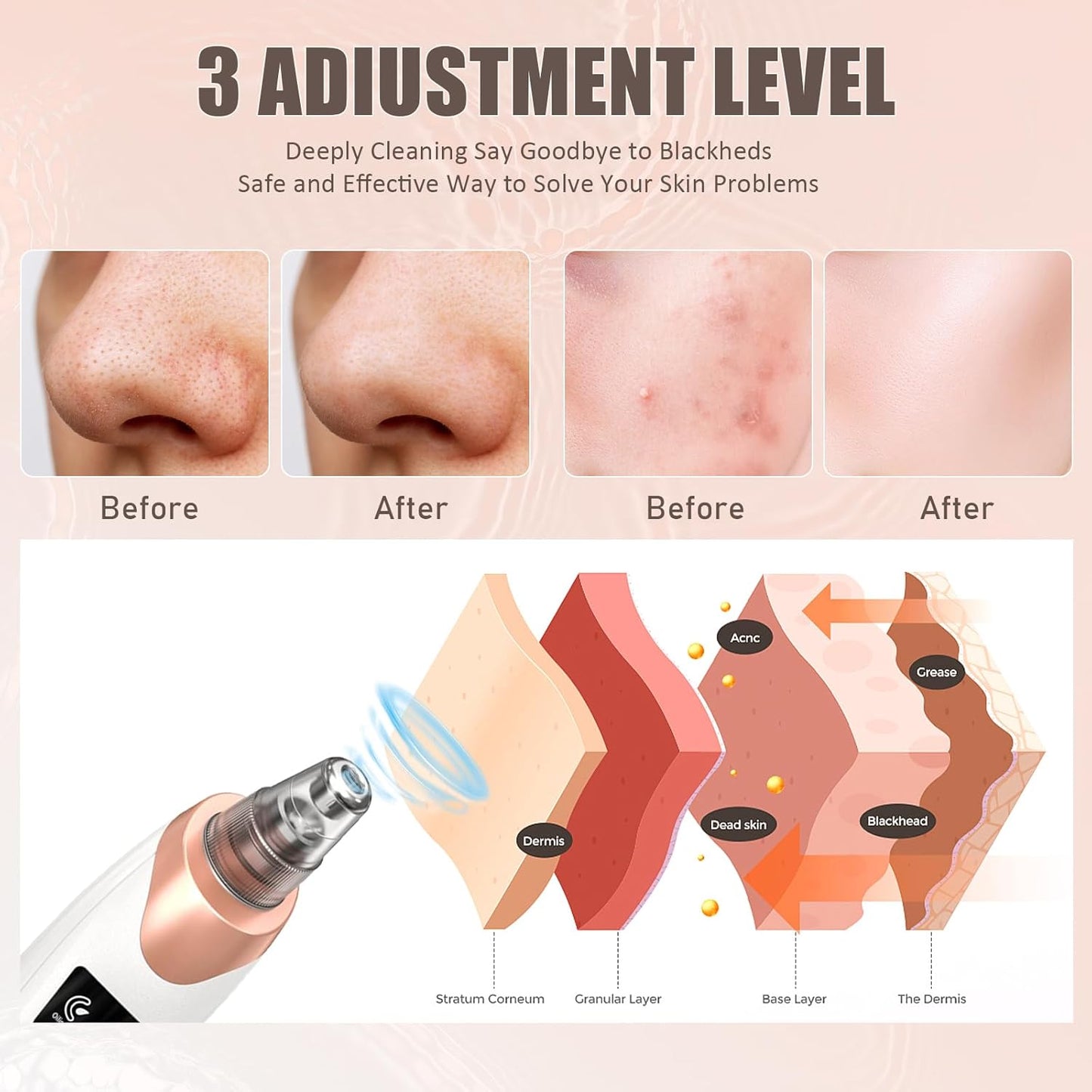 2026 Blackhead Remover Pore Vacuum,Facial Pore Cleaner-5 Suction Power,5 Probes,USB Rechargeable Blackhead Vacuum Kit Electric Acne Extractor Tool for Adult