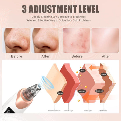 2026 Blackhead Remover Pore Vacuum,Facial Pore Cleaner-5 Suction Power,5 Probes,USB Rechargeable Blackhead Vacuum Kit Electric Acne Extractor Tool for Adult